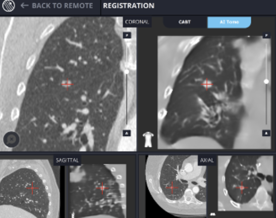 LungVision Real-Time Imaging for Ground Glass Opacities (GGOs) LungVision Real-Time Imaging for Ground Glass Opacities (GGOs)